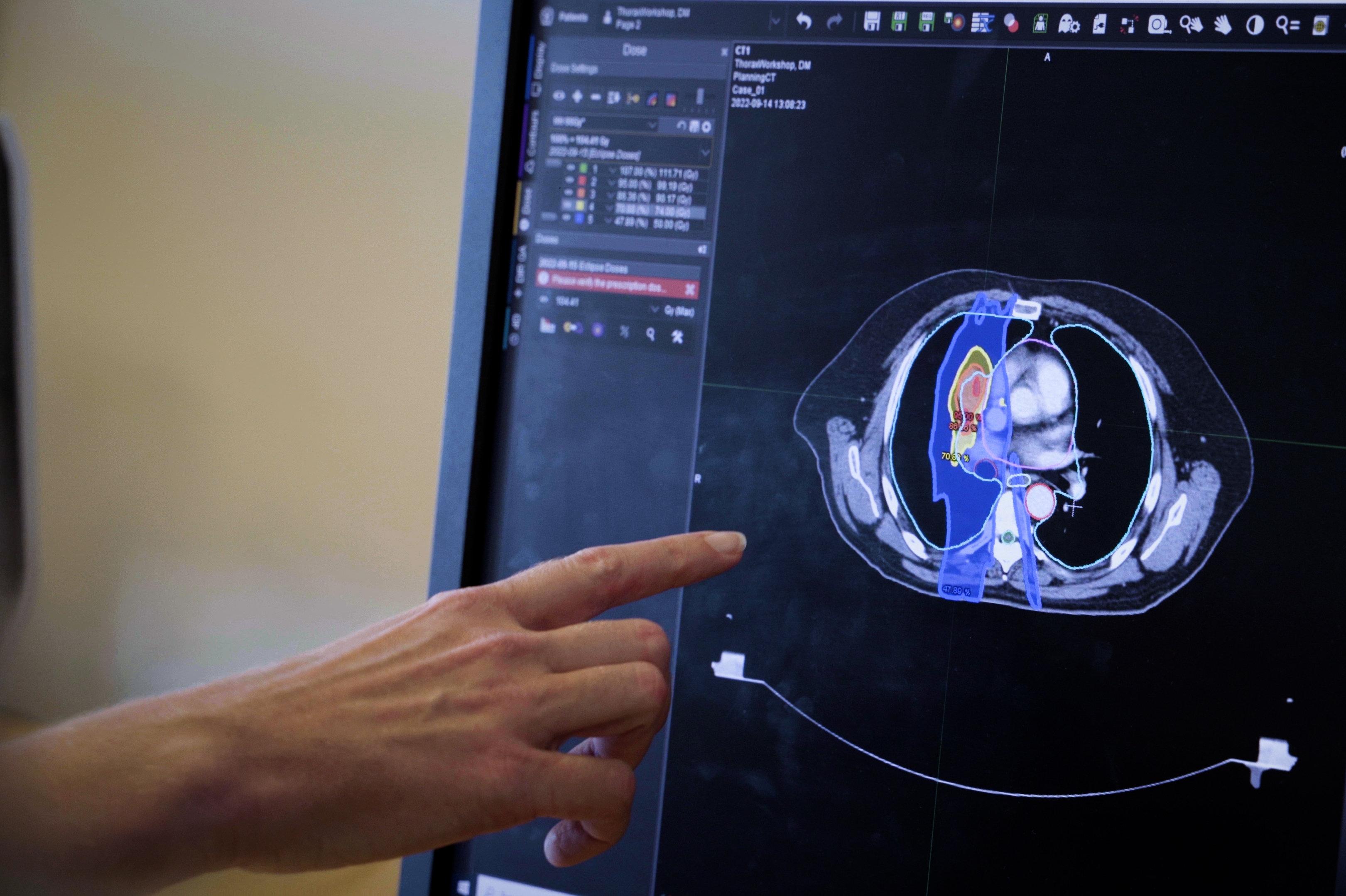 Med kunstig intelligens kan læger eller radiologers omstændelige arbejde med at lokalisere patientens organer før strålebehandling afløses af kunstig intelligens lige så sikkert og markant hurtigere. 